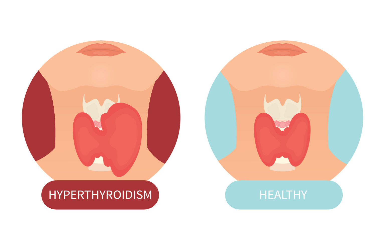 6 Symptoms Of Thyroid Disorders - A Nation of Moms