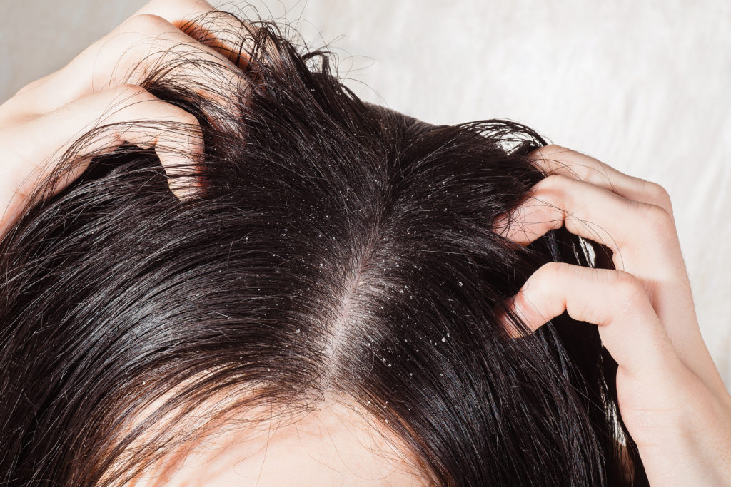 4 Ways To Treat A Dry Scalp - A Nation of Moms