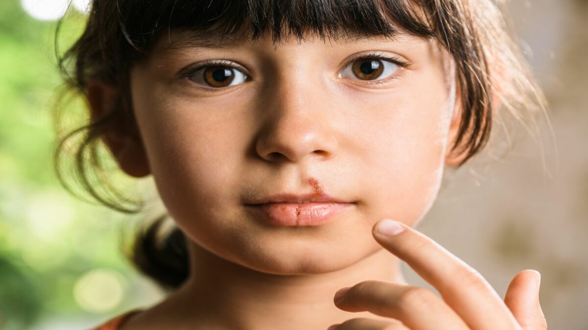 Cold Sores In Kids What Parents Need To Know A Nation of Moms